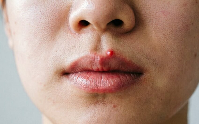 a pimple on your lip